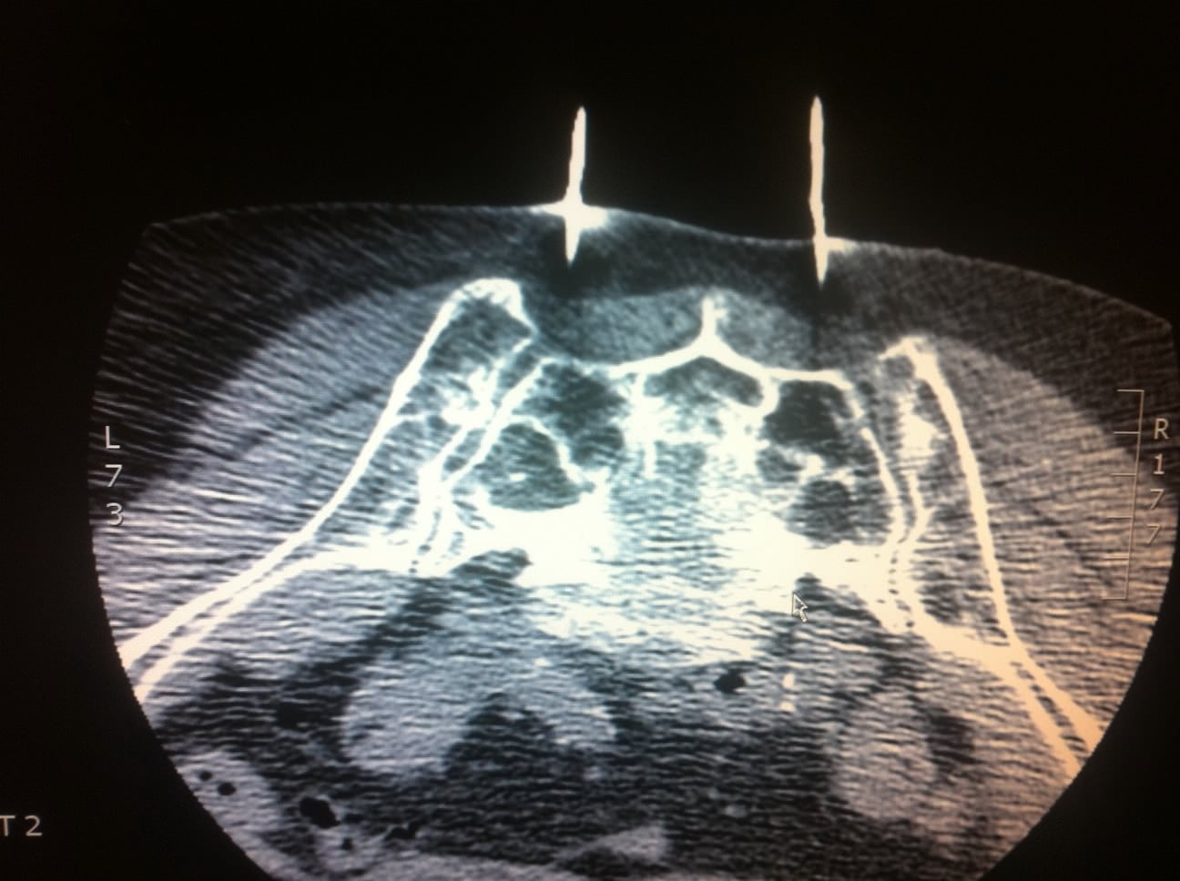 FRACTURES DU SACRUM INTERVENTIONAL RADIOLOGY