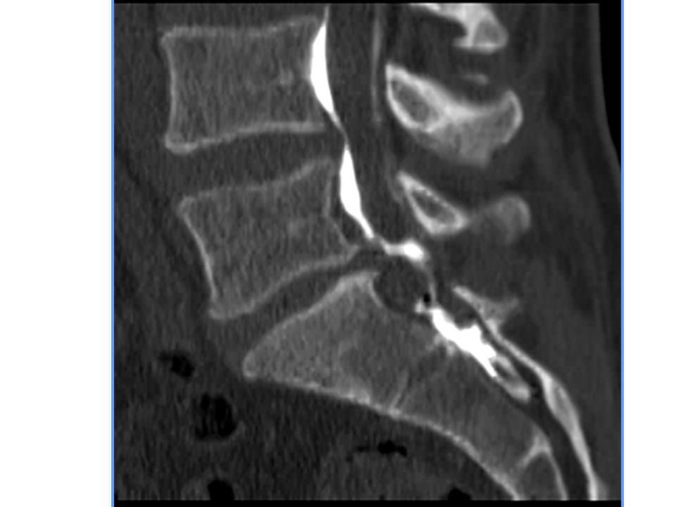 figure 11 epidurographie montrant la diffusion de l’infiltration épidurale INTERVENTIONAL