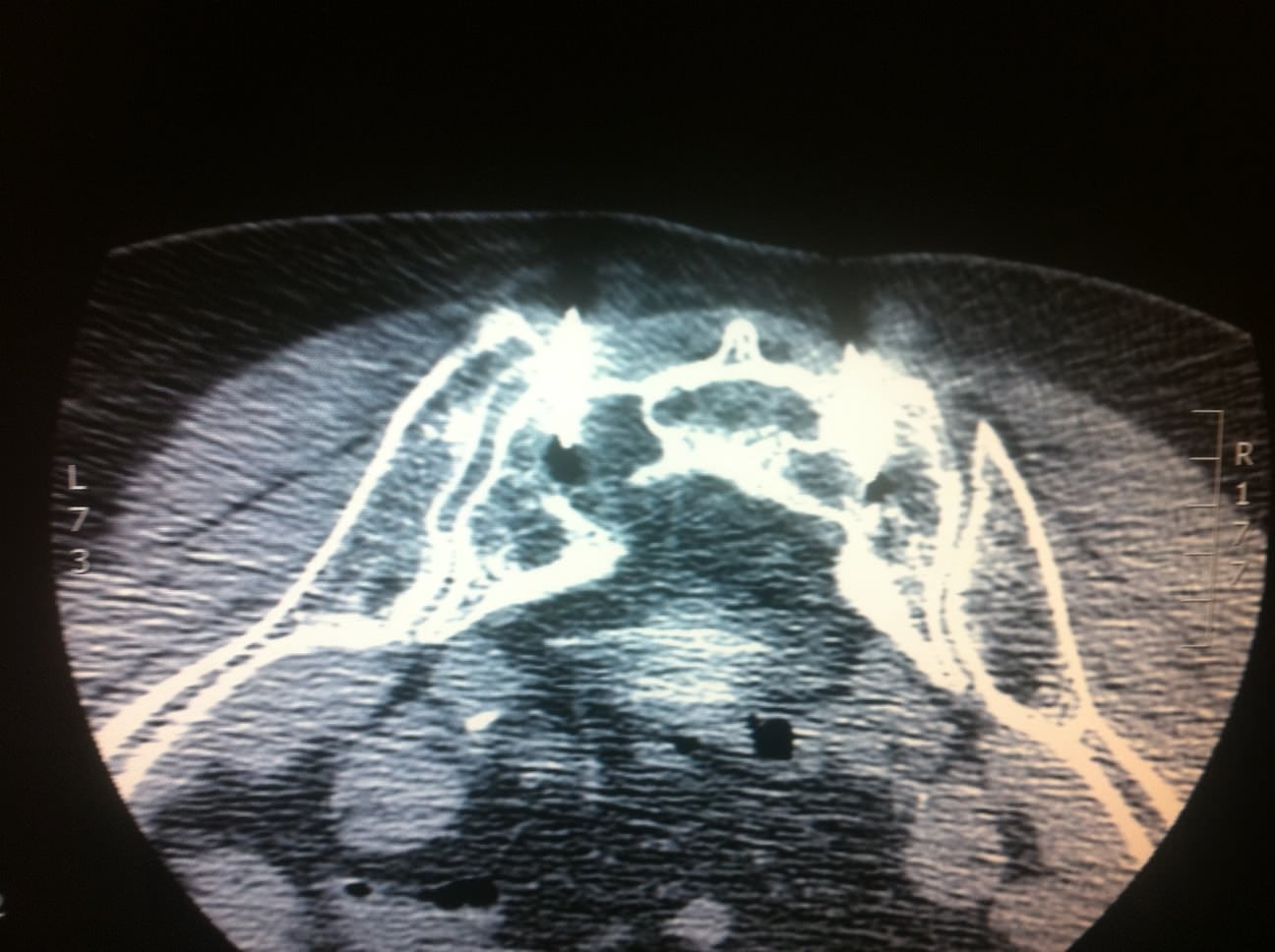 FRACTURES DU SACRUM INTERVENTIONAL RADIOLOGY