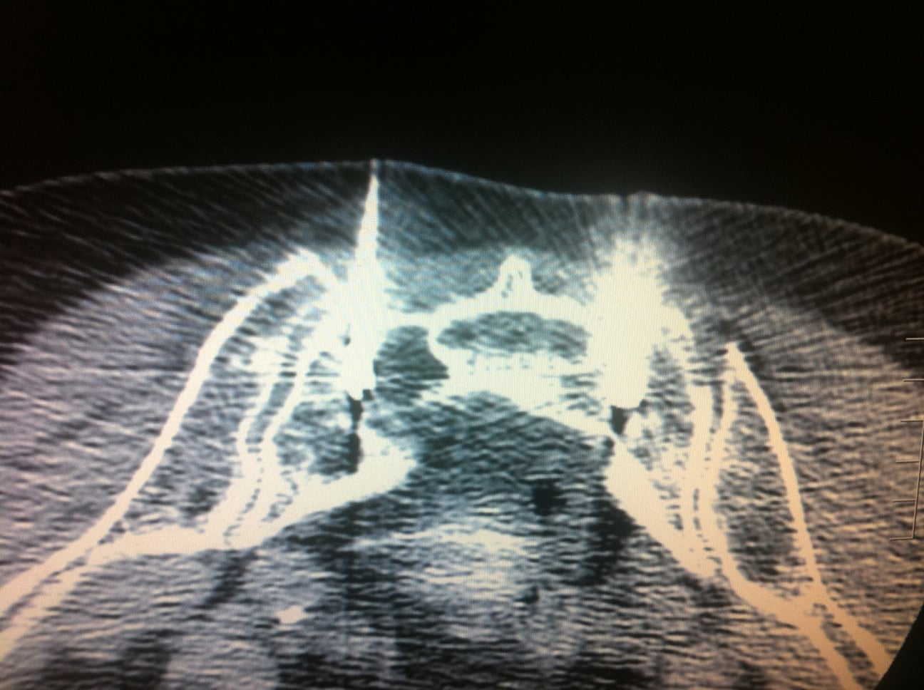 FRACTURES DU SACRUM INTERVENTIONAL RADIOLOGY